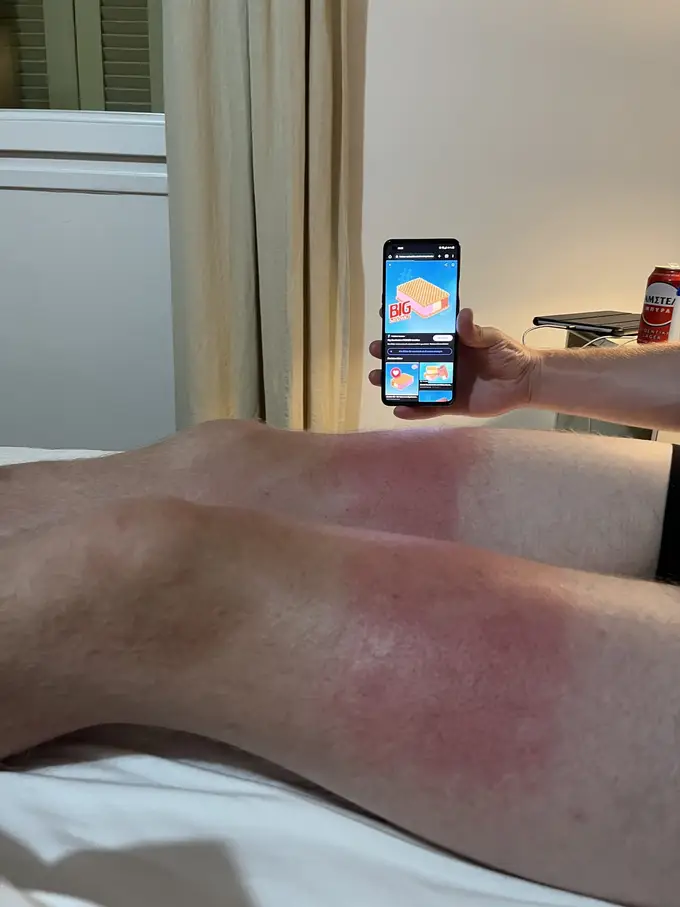 Beine auf einem Bett mit scharf abgegrenztem Sonnenbrand, die Unterschenkel gebräunt, die Oberschenkel rot